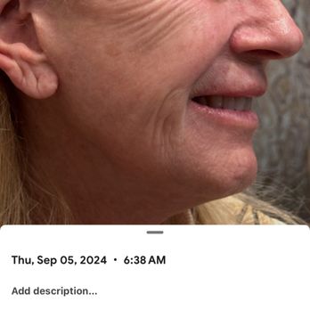 Carolina Facial Plastics - morning of facelift - Cosmetic Surgeons Near Me - Charlotte, North Carolina