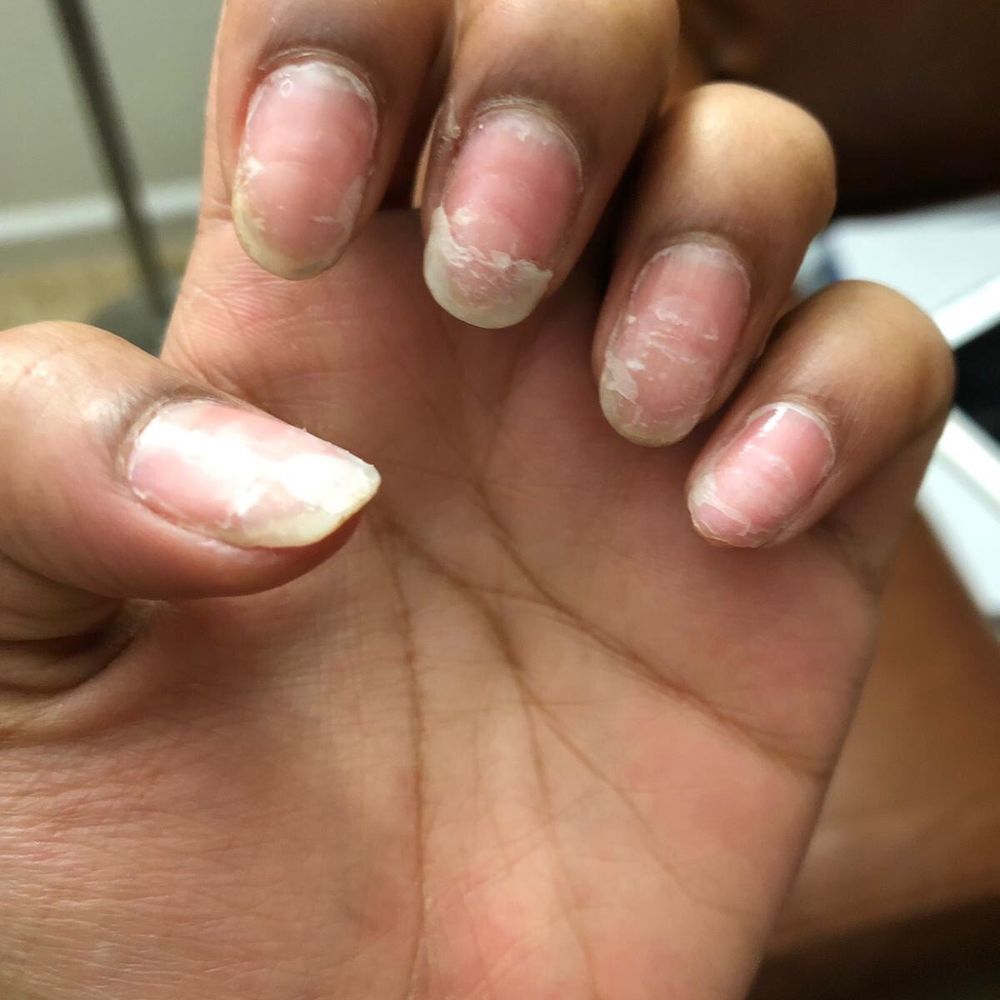 Coco Nails Spa - The results from only removing my acrylic nails here. - Nail Salons Near Me - Lincoln, California Coco Nails Spa - The results from only removing my acrylic nails here. - Nail Salons Near Me - Lincoln, California