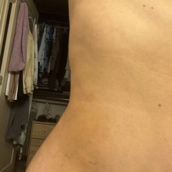 Donald W Hause, MD, FACS - My curve from waistline to hips