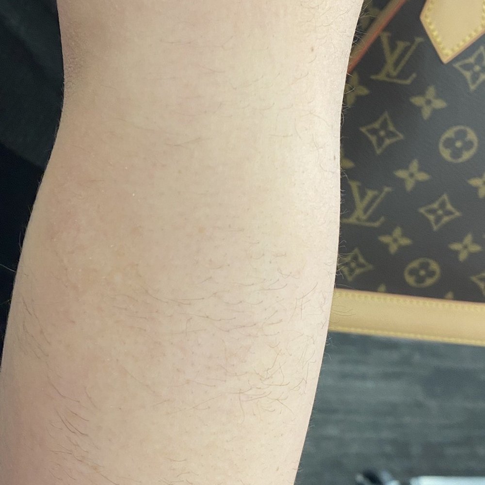 SEV Laser - Lol I was left with a hairy sleeve type of style & patchy - Laser Hair Removal Near Me - Rancho Cucamonga, California SEV Laser - Lol I was left with a hairy sleeve type of style & patchy - Laser Hair Removal Near Me - Rancho Cucamonga, California