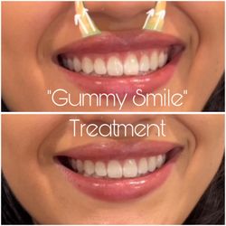 E&G Aesthetic Institute - Gummy Smile Treatment