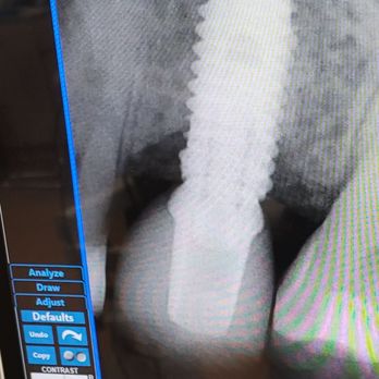 Kaizen Dental - Tooth implant after 1 year - Orthodontists Near Me - Paramount, California Kaizen Dental - Tooth implant after 1 year - Orthodontists Near Me - Paramount, California
