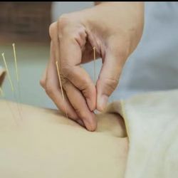 Integrated Wellness - Acupuncture for treatment!