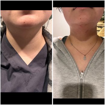 The Medspa - Kybella chin reduction. - Skin Care Near Me - Brooklyn, New York The Medspa - Kybella chin reduction. - Skin Care Near Me - Brooklyn, New York