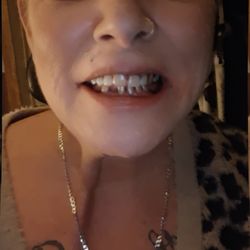 Creekside Dental - My gorgeous new top teeth Thk u dr annone ur the best.