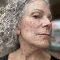 Jennifer Day Spa - Welts from High Frequency Micro current facial.