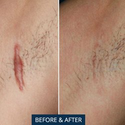 Ageless Rejuvenation Center - CO2 Ablative Laser Scar Reduction. Reduces scars, stretch marks, burns, and wrinkles.