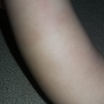 CHOC Children's - Children's Hospital of Orange County - Bruise on his arm from how tight they held him or how tight the tourniquet was. Other arm has no bruise. It has faded too. - Hospitals Near Me - Orange, California CHOC Children's - Children's Hospital of Orange County - Bruise on his arm from how tight they held him or how tight the tourniquet was. Other arm has no bruise. It has faded too. - Hospitals Near Me - Orange, California