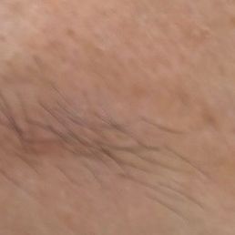 After three sessions, all the black pigment is gone, with only a slight red tinge at the ends. After three sessions, all the black pigment is gone, with only a slight red tinge at the ends.