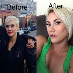 La Belle Vie Medical Care & Aesthetics - Before & After