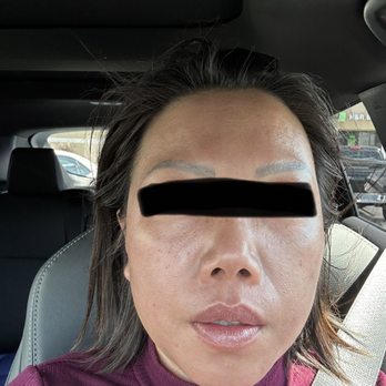 Newport Body Works - After just 2 treatments - Medical Spas Near Me - Costa Mesa, California Newport Body Works - After just 2 treatments - Medical Spas Near Me - Costa Mesa, California