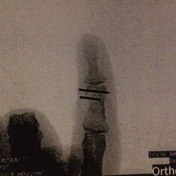 Hoag Orthopedic Institute Surgery Center - Two pins to set in place to heal right