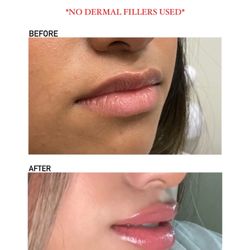 Sylvan Beach Med Spa - Lip Flip