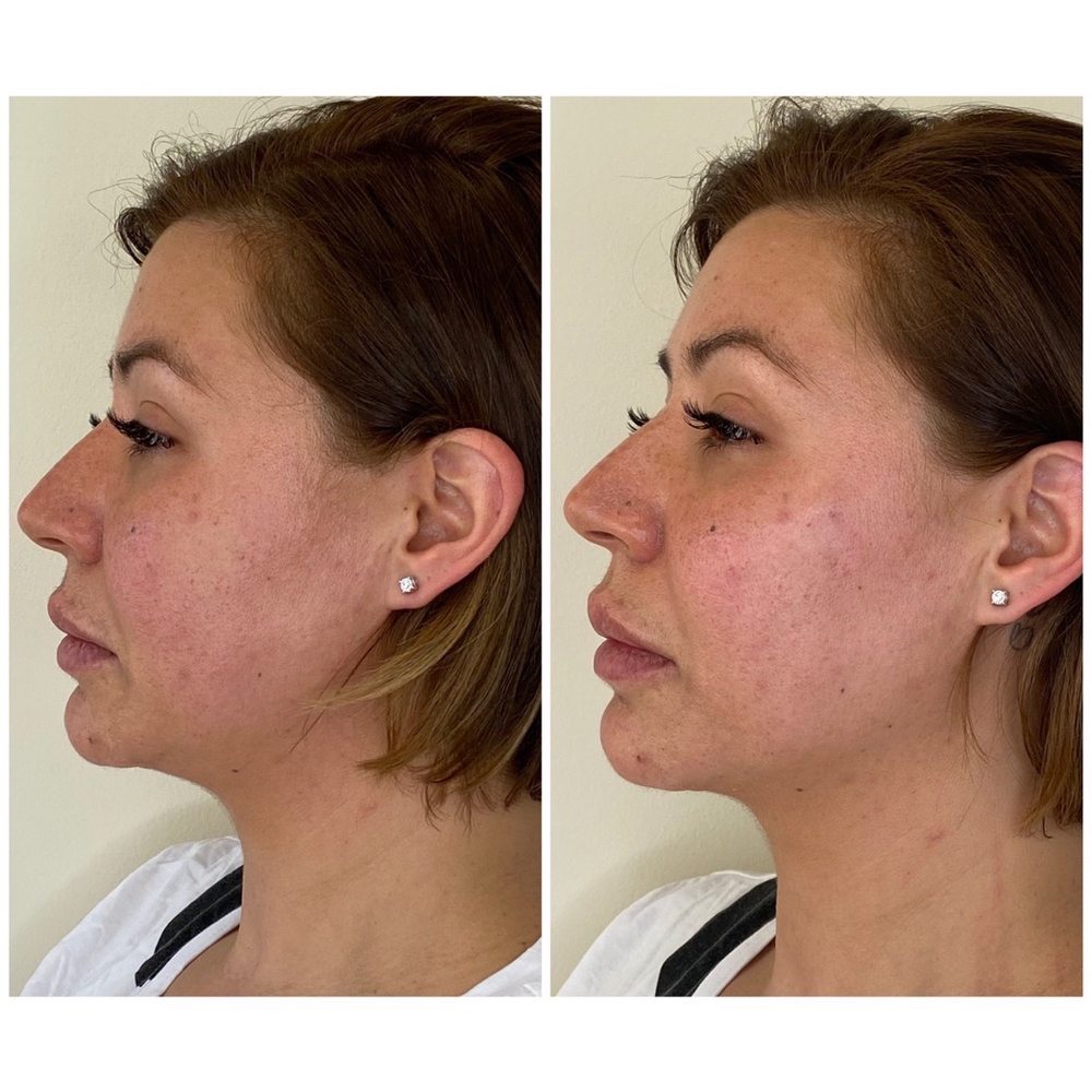 SkinSplendid - Before and after my amazing silhouette thread lift! - Medical Spas Near Me - Montclair, New Jersey