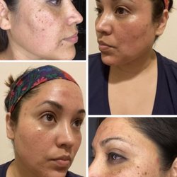 The Skincare Extraordinaire - Here are my results from less than a year of seeing Tammi.