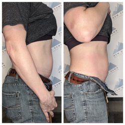 New Dawn Rejuvenation - 1 Treatment of CryoSlimming