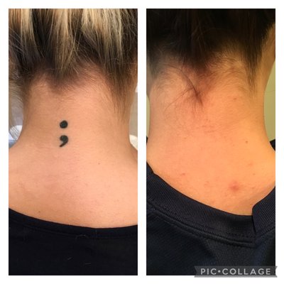 Before and After Tattoo Removal - When you're results driven, your work speaks for itself. Before and After Tattoo Removal - When you're results driven, your work speaks for itself.