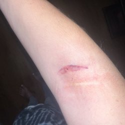 ADMA BioCenters - Myrtle Beach - Messed up arm