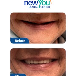 New You Dental Center - Our patient before and after she got dentures at our office!