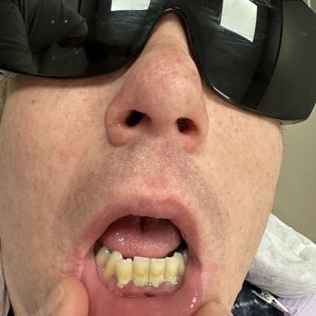 Dentique - Before shot! Gum disease - Cosmetic Dentists Near Me - San Diego, California Dentique - Before shot! Gum disease - Cosmetic Dentists Near Me - San Diego, California