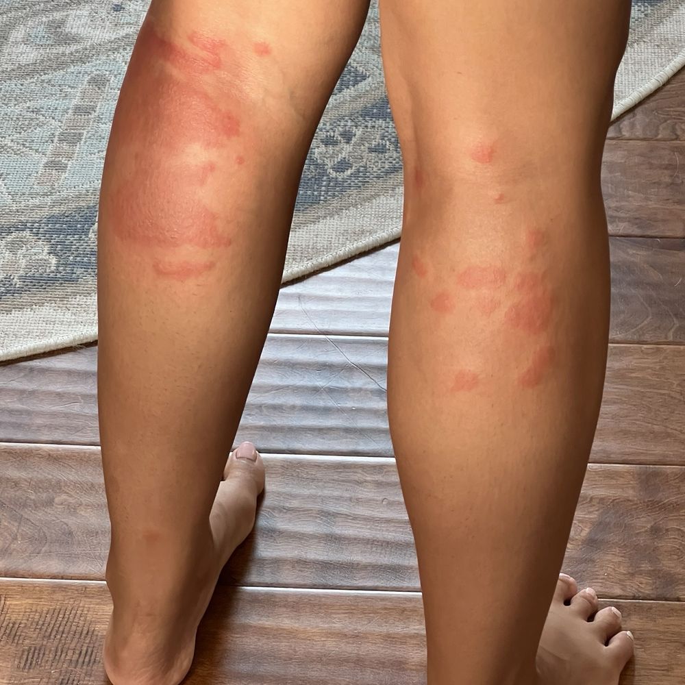 Skeeter's Mesquite Grill - Bad rash chemical burn from cleaner used at the restaurant - Burgers Near Me - Houston, Texas