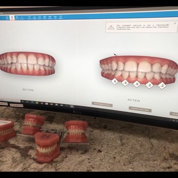 Grand Orthodontics - Left is what my teeth look like after braces are off and the right is what they could look like if I got braces yet again - Orthodontists Near Me - El Segundo, California Grand Orthodontics - Left is what my teeth look like after braces are off and the right is what they could look like if I got braces yet again - Orthodontists Near Me - El Segundo, California