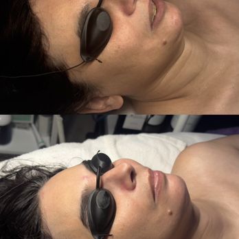 Harmony Elixir Spa - Before and after my facial - Estheticians Near Me - San Jose, California Harmony Elixir Spa - Before and after my facial - Estheticians Near Me - San Jose, California