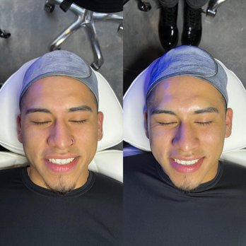 Esthetic Co & Spa - Before and After HydraFacial MD treatment. - Medical Spas Near Me - Phoenix, Arizona Esthetic Co & Spa - Before and After HydraFacial MD treatment. - Medical Spas Near Me - Phoenix, Arizona