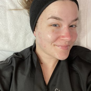 Cheng Plastic Surgery - After my first hydrafacial - Cosmetic Surgeons Near Me - Saratoga, California Cheng Plastic Surgery - After my first hydrafacial - Cosmetic Surgeons Near Me - Saratoga, California