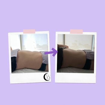 Luna Curves - Before and after results of our Bloat Therapy service. - Body Contouring Near Me - Artesia, California Luna Curves - Before and after results of our Bloat Therapy service. - Body Contouring Near Me - Artesia, California