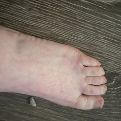 St Catherine's Hospital - Bruising on each side of my foot. Since there's a re injury of an old break, I'm to assume they squeezed my foot HARD.