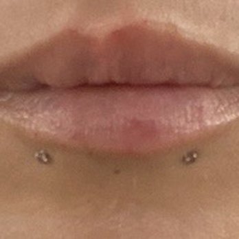 LaserAway - 2 weeks After 1st session - Medical Spas Near Me - Emeryville, California