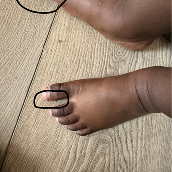 Evergreen - Staff repeatedly put size 9 shoes on my son size 10 feet, without telling us. He now has 2 corns on baby toes - Preschools Near Me - Bellevue, Washington Evergreen - Staff repeatedly put size 9 shoes on my son size 10 feet, without telling us. He now has 2 corns on baby toes - Preschools Near Me - Bellevue, Washington