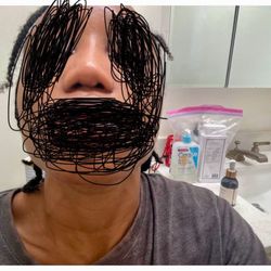 Tanya Judge MD - Nostrils after procedure before retainers that don't work.