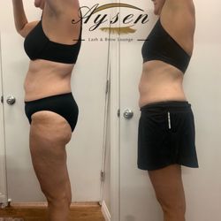 Aysen Beauty - RF skin tightening