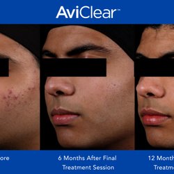 Orchid Medical Clinic - Aviclear is the only laser treatment that delivers long-lasting results for all severities of acne in all skin types.