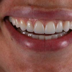 Alluna Dental - 10 natural veneers