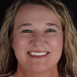 Advanced Dentistry of Amarillo - Smile restoration of missing 4 upper front teeth using an implant-supported cosmetic bridge