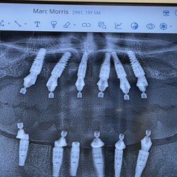 NewMe Dental Implant Specialist - My implants.