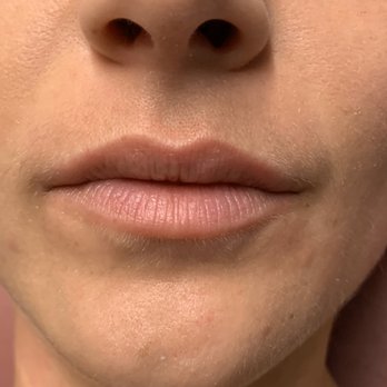 Plump Cosmetics & Injectables - Before filler - Medical Spas Near Me - New York, New York Plump Cosmetics & Injectables - Before filler - Medical Spas Near Me - New York, New York