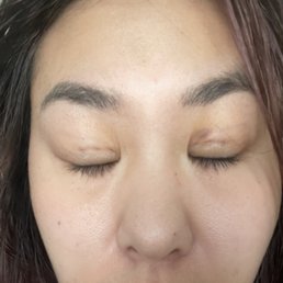 Feb 4 Immediately after surgery. Feb 4 Immediately after surgery.