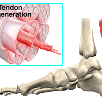 Global Podiatry - Achilles Tendonitis Treatment - Podiatrists Near Me - Chicago, Illinois Global Podiatry - Achilles Tendonitis Treatment - Podiatrists Near Me - Chicago, Illinois