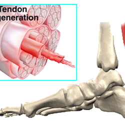 Achilles Tendonitis Treatment