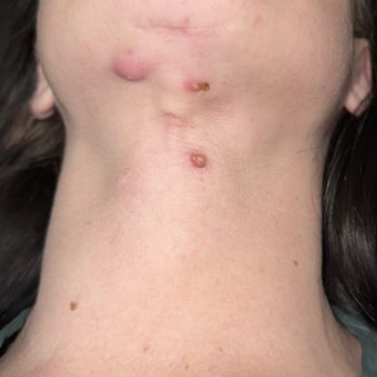 Austin Cosmetic Surgery - 1.5 years post initial surgery, these drain pus daily - Cosmetic Surgeons Near Me - Austin, Texas
