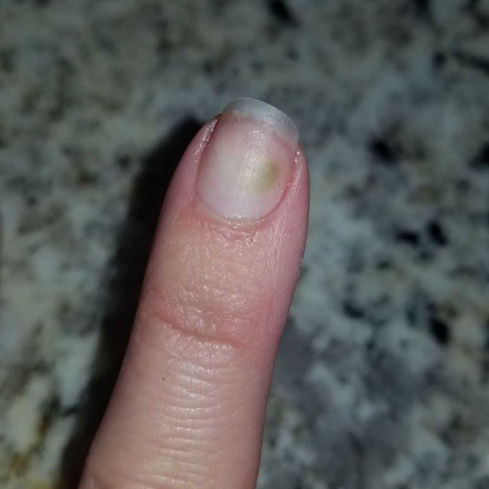 Nailuxe & Spa - Nasty fungus - Nail Salons Near Me - Saint Augustine, Florida