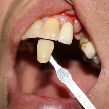Main Street Dental - Painful tooth? Tooth was removed and temp bridge placed same day (sleep dentistry). - Pediatric Dentists Near Me - Gresham, Oregon Main Street Dental - Painful tooth? Tooth was removed and temp bridge placed same day (sleep dentistry). - Pediatric Dentists Near Me - Gresham, Oregon