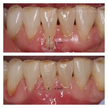 Eugenia Prokopets, DDS MSD - Connective Tissue Graft to treat root exposure - Cosmetic Dentists Near Me - Chevy Chase, Maryland Eugenia Prokopets, DDS MSD - Connective Tissue Graft to treat root exposure - Cosmetic Dentists Near Me - Chevy Chase, Maryland