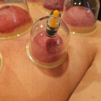 Agave Beauty & Spa - Cupping therapy - Skin Care Near Me - Whittier, California Agave Beauty & Spa - Cupping therapy - Skin Care Near Me - Whittier, California