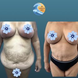 HB Surgical Arts - Patient results after Avelar Abdominoplasty