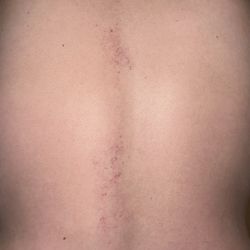 Hung Fu Massage - Bruising and scratches already had formed by the time I got home